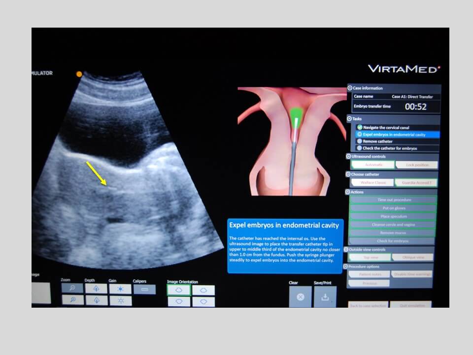 Overview of the ASRM Embryo Transfer Simulator Program and Findings fr ...