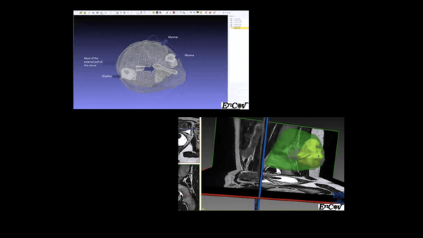 Augmented Reality in Gynecological Surgery